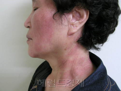 기습한파! 안면홍조 환자 3년새 18.2% 늘어