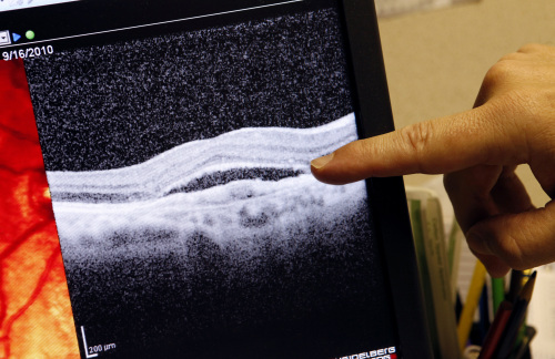 Dr. Karl Csaky looks at an image which shows a patient’s macular degeneration at Texas Retina
Associates in Dallas. (MCT)