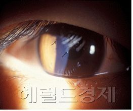건강/ 눈, 안구