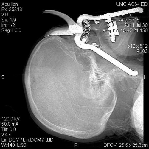 In this image provided by the University Medical Center in Tucson, a CT scan shows a pair of pruning shears embedded in the head of an 86-year-old Green Valley, Ariz., man before it was removed by Medical Center surgeons in Tucson on July 30. (AP-Yonhap News)