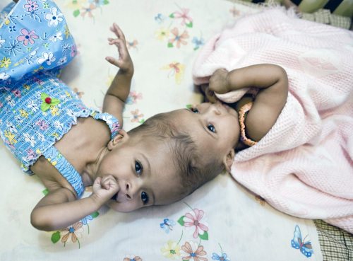 Undated handout photo released Sunday Sept.18, 2011 by British charity Facing the World of conjoined twins Rital and Ritag Gaboura (left to right not given) before they were successfully separated at London‘s Great Ormond Street Hospital for Children. (AP)