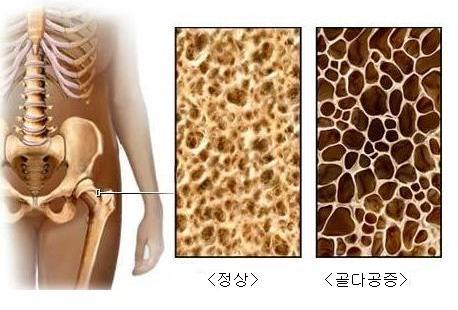 22일 의약계에 따르면, 고령사회로 접어들면서 노인성질환인 국내 골다공증 환자 수는 200만명에 이른다. 고령화가 진전될수록 환자수는 크게 증가할 전망이다.