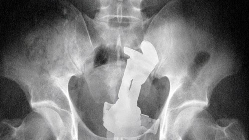 An x-ray from the book "Stuck Up"