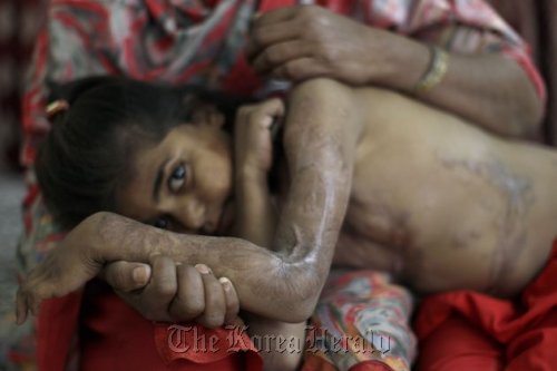An 8-year-old girl, who survived an alleged acid attack from her father, at the Acid Survivors Foundation in Islamabad, Pakistan, Tuesday. AP