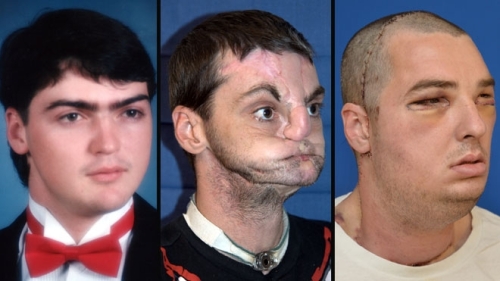 From left to right: face of Richard Norris before the accident, after the accident, and after the surgery. (Handout image from University of Maryland)