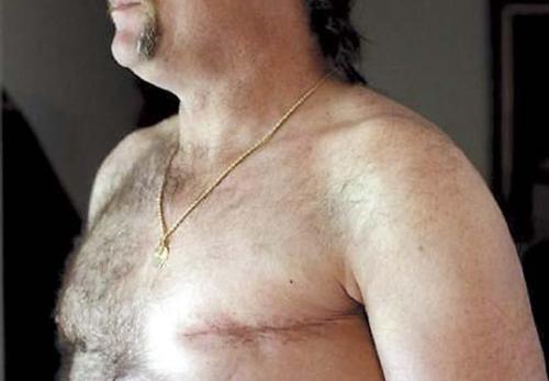 In this May 3, 2012 photo, a surgery scar is seen on breast cancer survivor Robert Kaitz’s left breast in his home in Severna Park, Md. Kaitz thought a small growth under his left nipple was just a harmless cyst. By the time he had it checked out in 2006, almost two years later, the lump had started to hurt. The diagnosis was a shock. “I had no idea in the world that men could even get breast cancer,” Kaitz said. Now Kaitz does frequent self-exams and has mammograms every year. The American Cancer Society estimates 1 in 1,000 men will get breast cancer, versus 1 in 8 women. (AP Photo/Patrick Semansky)