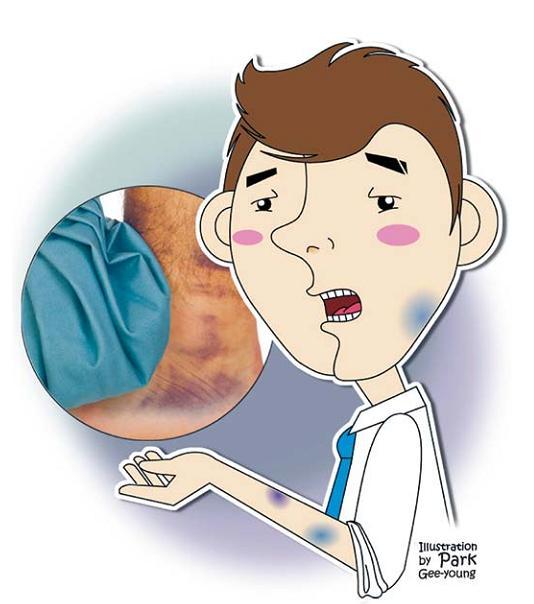 Reasons for bruising