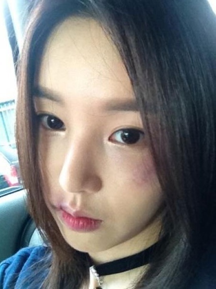 남규리, 영화배우, 가수/남규리 얼굴에 멍자국 왜?