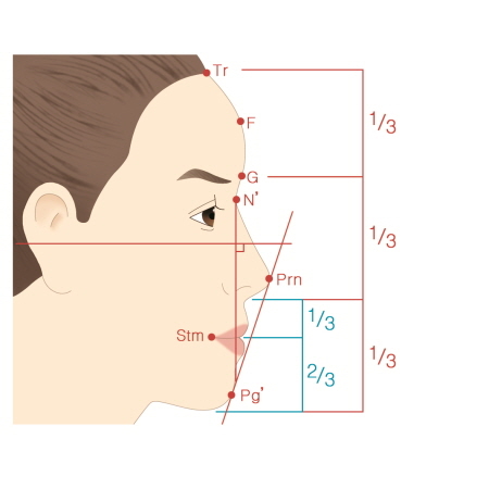양악수술은 이제 그만? 대안은…