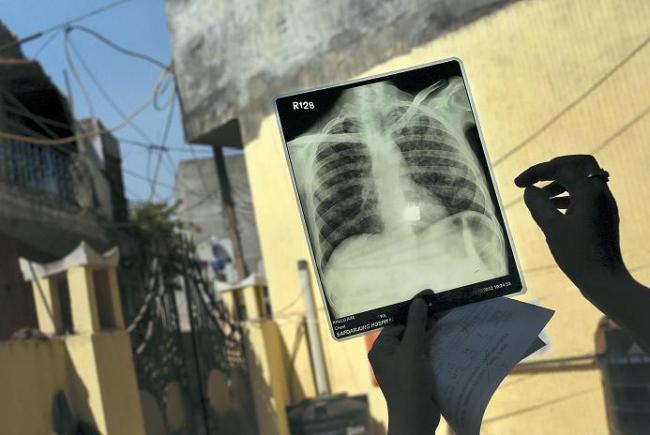 A counselor looks at the X-ray of a patient suffering from both tuberculosis and HIV at an Operation ASHA program center in New Delhi. (AP-Yonhap News)
