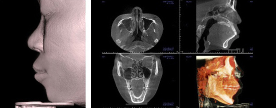 A 3-D CT scan image of a patient with bimaxillary protrusion.   Braun Plastic Surgery