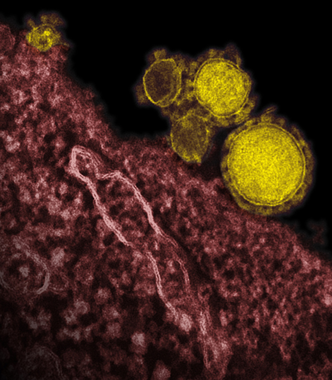 This undated electron microscope image made available by the National Institute of Allergy and Infections Diseases ― Rocky Mountain Laboratories shows novel coronavirus particles, also known as the MERS virus, colorized in yellow.   AP-Yonhap News