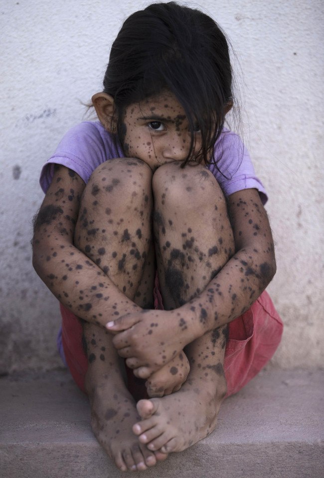 Aixa Cano, 5, who has hairy moles all over her body that doctors can’t explain, sits on a stoop outside her home in Avia Terai, Argentina. Doctors say her birth defect may be linked to agrochemicals.   AP-Yonhap News