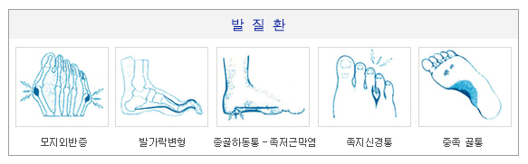 꽉끼고 뾰족한 신발 금물…굽은 2.5~3㎝ 적당