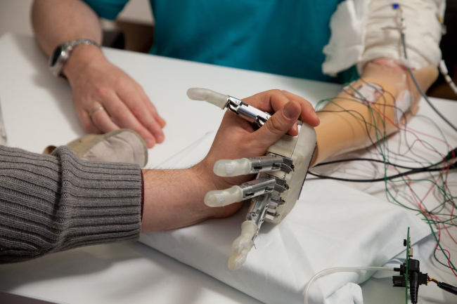 An amputee tries out the sensory feedback-enabled artificial hand in Rome.   AP-Yonhap