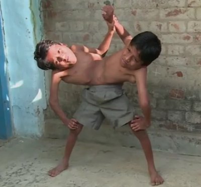 상반신은 분리되어 있으나 하반신은 하나로 붙어 살고 있는 인도 샴쌍둥이 형제가 “분리수술을 원치 않는다”고 밝혀 화제가 되고 있다.
올해 12살인 시바나드 사후와 시브람 사후 형제는 복부부터 하반신이 붙어있으나 독립적인 뇌, 폐와 심장을 가지고 태어났다.
그러나 분리 수술이 가능하다는 의사의 말에도 불구, 두 형제는 수술을 원치 않는다고 전했다.