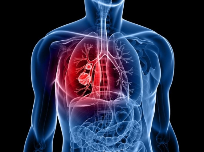 Korean researchers have identified a new type of microRNA molecule which suppresses a gene that plays an important part in lung cancer, the National Research Foundation of Korea said Sunday.