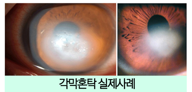 라식/라섹 수술 전 체크사항! 각막이 뿌옇게 변하는 각막혼탁 부작용 - 헤럴드경제