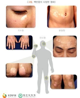 멜라닌 색소가 파괴돼 몸에 하얀 반점이 생기는 백반증 환자가 매년 증가하고 있는 가운데 자외선 노출이 많은 여름에 가장 증가율이 높은 것으로 알려졌다.
2008~2013년 월별 진료인원 추이를 살펴보면 백반증 치료를 위해 병원을 찾은 환자 수는 자외선에 노출이 많은 7월~9월에 가장 많은 것으로 드러나 여름철에 특히 주의해야 하는 것으로 알려졌다.