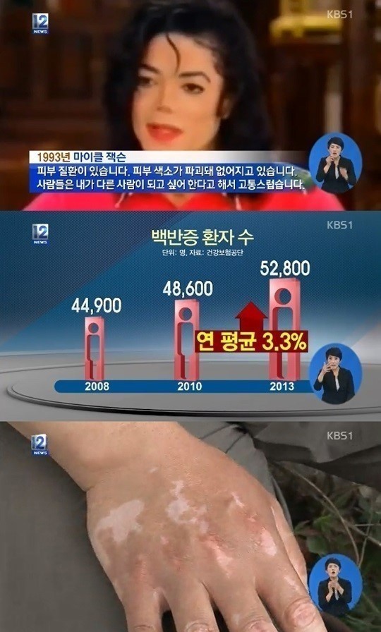 ▲ 백반증 환자 증가 마이클잭슨 / KBS