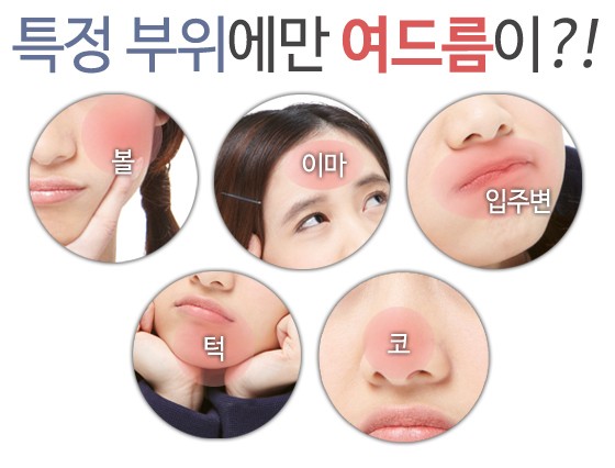 특정 부위만 나는 여드름 왜?