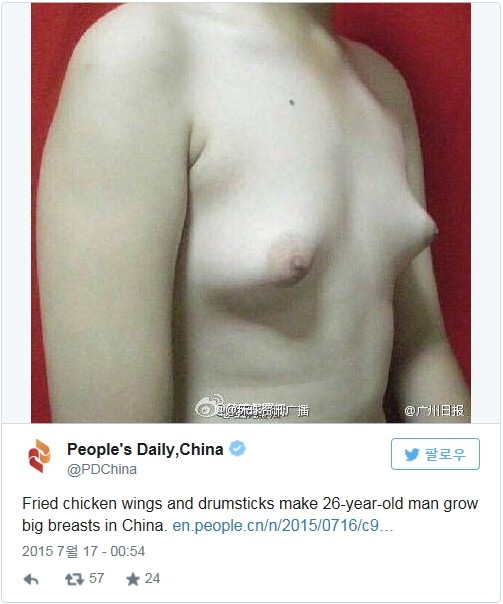 치킨 먹고 女유방이 된 남자가슴…무슨일이?