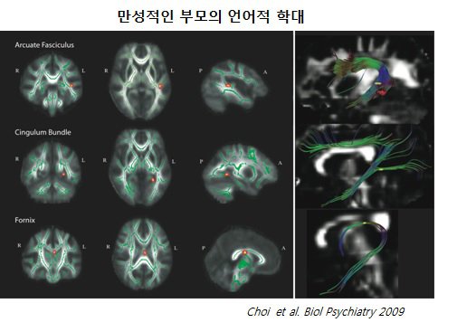A brain scan of a young Korean adult who was abused as a child shows long-term changes in key brain circuits.    Yonhap