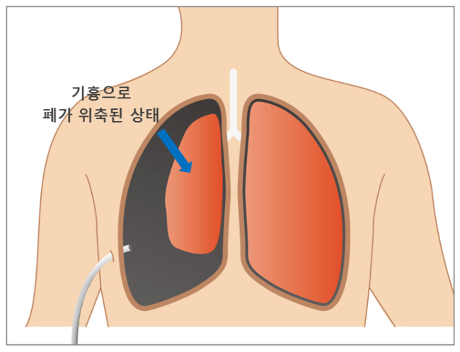 기흉은 옆구리에 관을 꼽아 공기를 제거하고 퇴원할 수 있지만, 재발률이 높아 흉강경 수술로 기낭을 제거하는 것이 근본적인 치료법이다.[그래픽=강동경희대병원]
기흉은 옆구리에 관을 꼽아 공기를 제거하고 퇴원할 수 있지만, 재발률이 높아 흉강경 수술로 기낭을 제거하는 것이 근본적인 치료법이다.[그래픽=강동경희대병원]