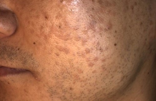 재발하는 얼굴 편평사마귀, 뜯지 말고 치료해야..