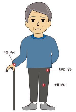 겨울철 낙상으로 골절이 생기기 쉬운 부위. [제공=강동경희대병원]
