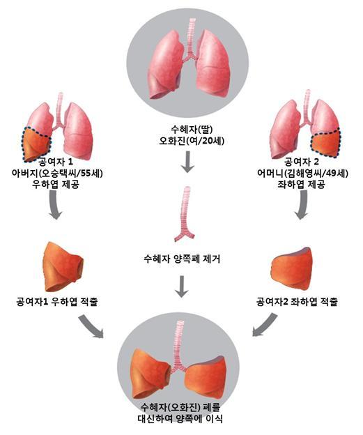 생체 폐 이식 수술 모식도. [제공=서울아산병원]