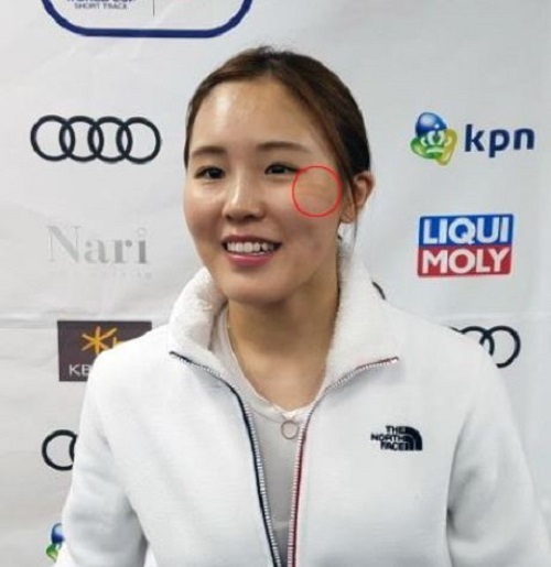 South Korean short track speed skater Kim A-lang speaks to reporters during International Skating Union World Cup Short Track Speed Skating at Mokdong Ice Rink in Seoul on Nov. 17, 2017. The red circle shows bandages over a scar Kim sustained after taking a skate blade to the face during an earlier race in Seoul. (Yonhap)
