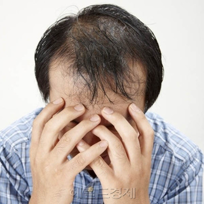 [설명=대표적인 탈모치료제인 프로페시아는 승승장구하는 반면 아보다트는 제네릭 공세에 매출이 하락하고 있다. 사진은 탈모 관련 이미지.]