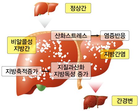 비알콜성지방간 생성 경로［제공=한국한의학연구원］