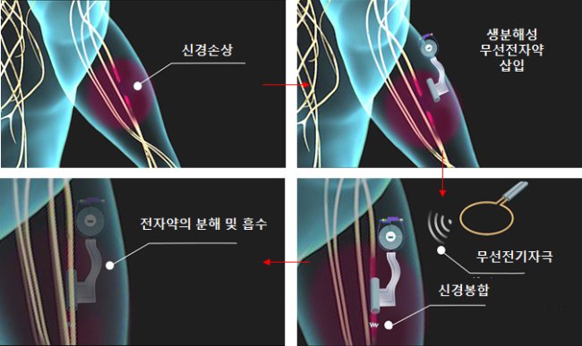 생분해성 전자약의 신경치료 시나리오 모식도.[제공=KAIST]