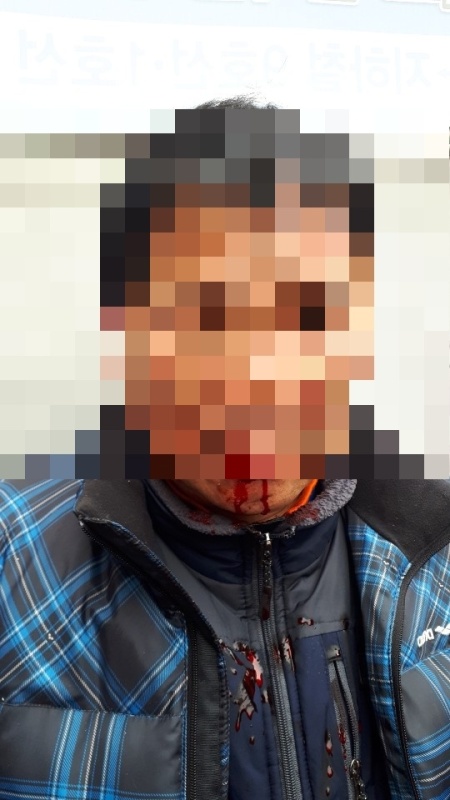 지난 11일 노량진 구시장에서 수협 직원들과 싸우다가 치아가 부러지고 입술이 터져 스물다섯바늘을 꿰맨 강모(55) 씨. 당시 현장 사진. [노량진수산시장 현대화 비대위 제공]