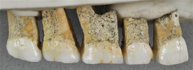 <YONHAP PHOTO-1547> This undated photo provided by the Callao Cave Archaeology Project in April 2019 shows the right upper teeth of the individual CCH6 of the newly discovered species Homo luzonensis. From left are two premolars and 3 molars. In a study released on Thursday, April 10, 2019, scientists report that tests on two samples from the species show minimum ages of 50,000 years and 67,000 years. (Callao Cave Archaeology Project via AP)/2019-04-11 02:03:45/ <저작권자 ⓒ 1980-2019 ㈜연합뉴스. 무단 전재 재배포 금지.>
<YONHAP PHOTO-1547> This undated photo provided by the Callao Cave Archaeology Project in April 2019 shows the right upper teeth of the individual CCH6 of the newly discovered species Homo luzonensis. From left are two premolars and 3 molars. In a study released on Thursday, April 10, 2019, scientists report that tests on two samples from the species show minimum ages of 50,000 years and 67,000 years. (Callao Cave Archaeology Project via AP)/2019-04-11 02:03:45/ <저작권자 ⓒ 1980-2019 ㈜연합뉴스. 무단 전재 재배포 금지.>