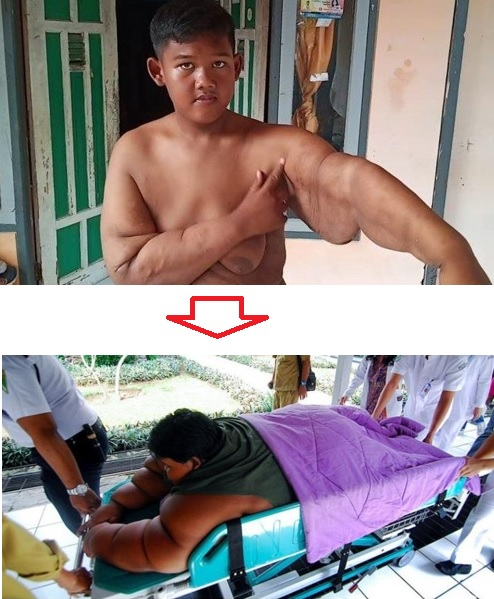 몸무게 200㎏에 육박하던 한 인도네시아의 소년이 위 축소 비만 수술을 받은 후 달라진 모습을 27일 현지 언론에 공개해 화제다. 아래는 2016년 10살 당시 모습. [트리뷴뉴스·일간 콤파스]