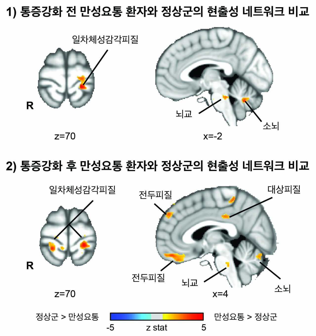만성요통 환자와 정상군 간의 현출성 네트워크 비교.[한국한의학연구원 제공]