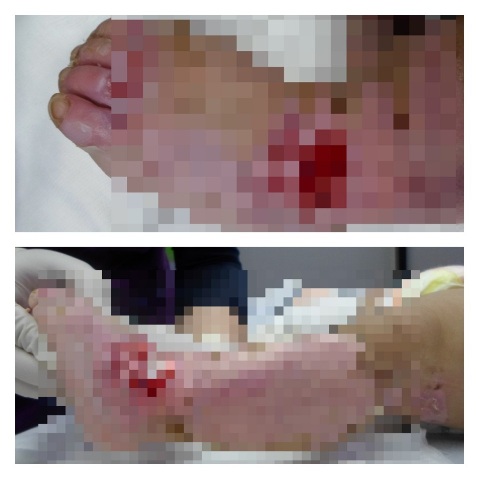 지난해 11월 어린이집에서 화상을 입었을 당시 모습. 어린이집 교사는 자신의 과실로 화상을 입은 아이를 수차례 학대한 것으로 드러났다. [피해 부모 제공]