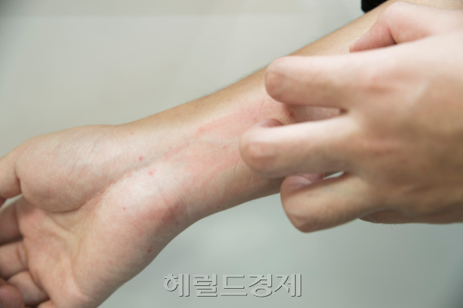 환절기에는 피부가 건조해져 가려움을 호소하는 사람이 많다. 충분한 보습을 해주는 것이 필요하다.