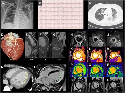 A and C are X-ray and CT images of a patient’s chest that show increased cardiac size. B shows abnormal ECG findings. E, F and G show the patient is without preexisting coronary artery illness. N and O are MRIs that show swelling in the heart. (European Heart Journal)
