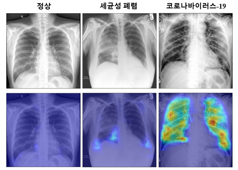 코로나19 진단 알고리즘을 통해 얻은 코로나19 확률 분포 특징 지도의 예. 다른 병변에서는 의심되는 영역이 거의 나타나지 않았으나 코로나19의 경우 고화질로 의심이 되는 부분이 표시되는 것을 볼 수 있다.[KAIST 제공]