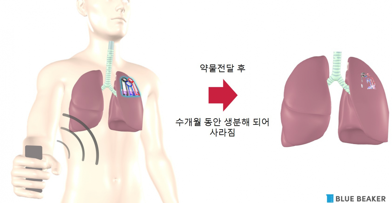 무선 약물전달 의료기기 개념도.[고려대학교 제공]