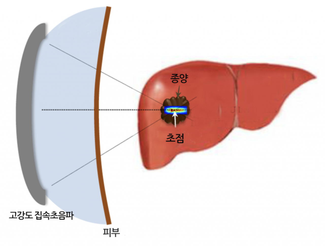 고강도 집속초음파 기반 생체조직 파쇄 기술 개념도.[KIST 제공]