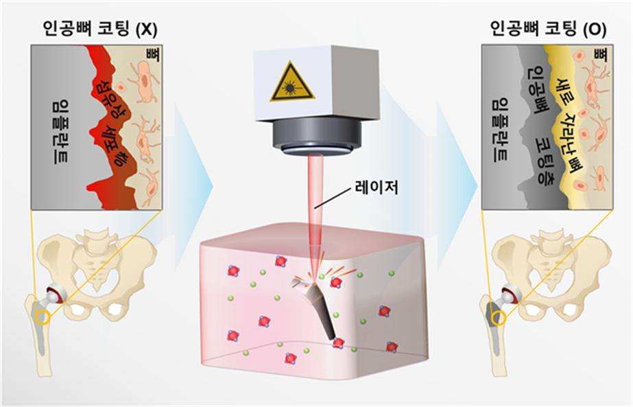 레이저를 이용해 인공뼈를 세계 최고속 수준으로 구현한 방법과 형성된 코팅층의 구조를 보여주는 모식도.[KIST 제공]