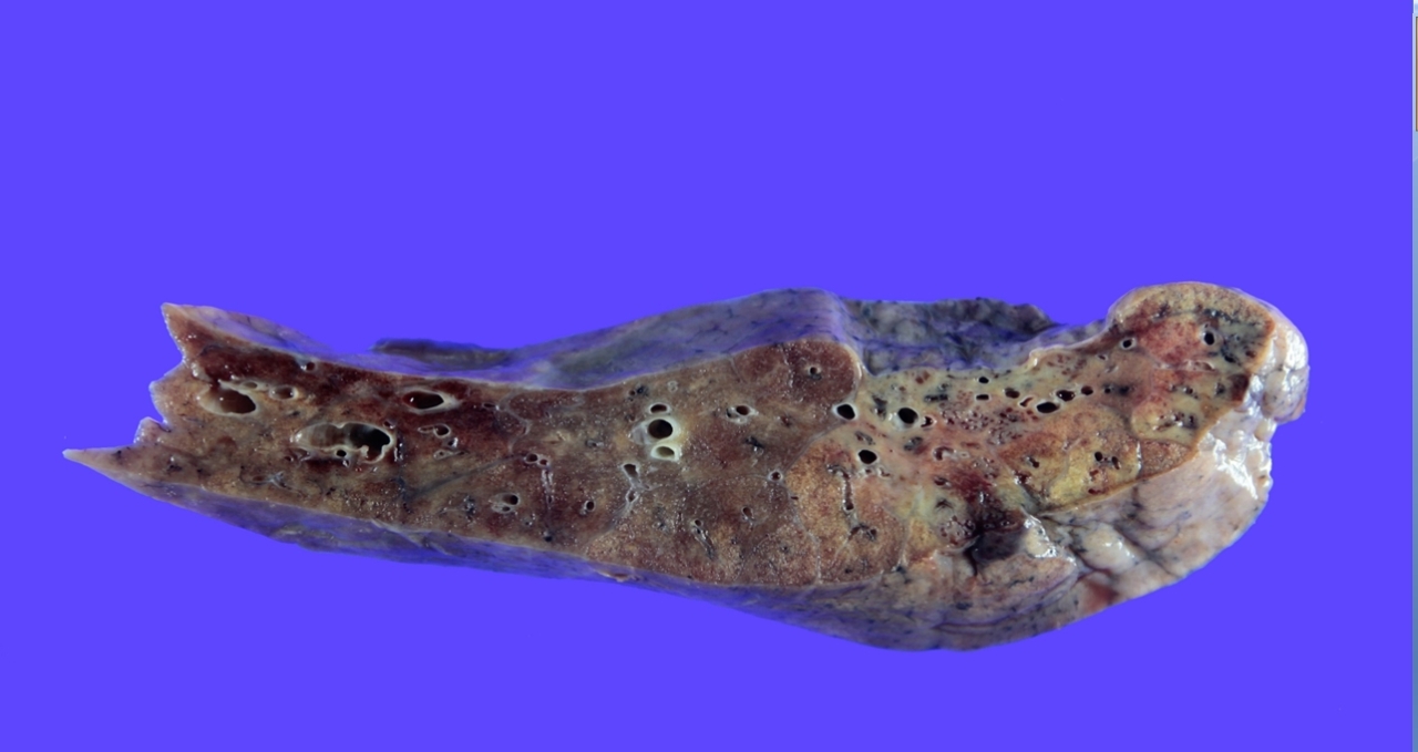 Photo shows the lung of a COVID-19 patient (courtesy of the Hallym University Sacred Heart Medical Center)