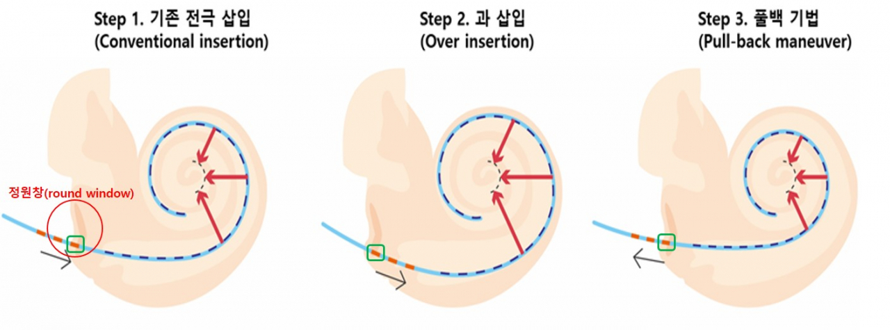 풀백수술기법