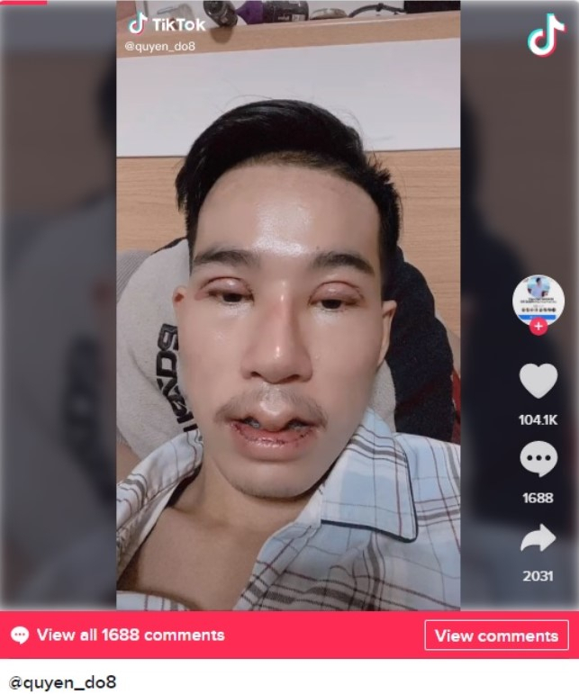 도 쿠엔이 올린 성형수술 직후 사진. [틱톡 캡처]