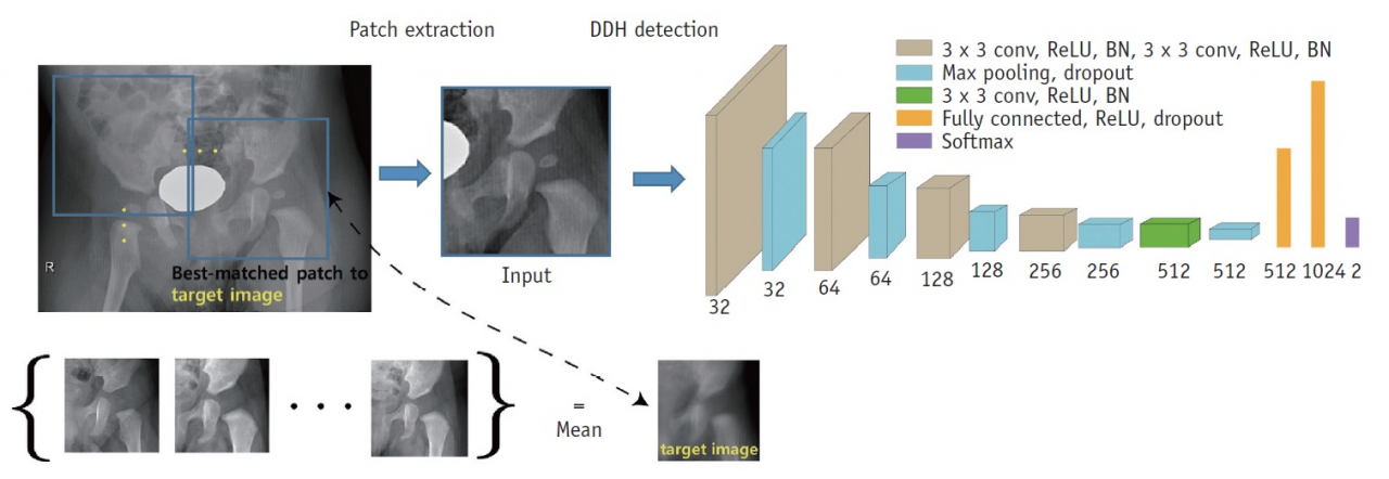 소아 고관절 이형성증 검출 방법 모식도.[국가수리과학연구소 제공]